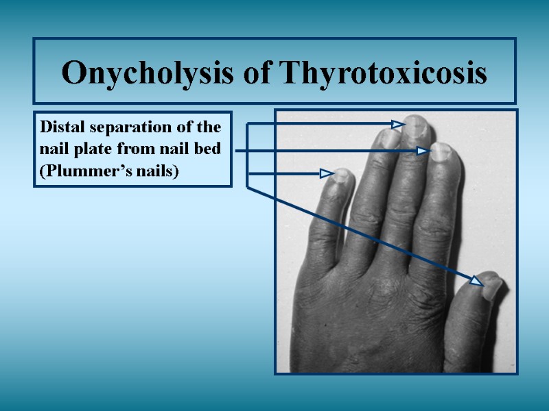 Onycholysis of Thyrotoxicosis Distal separation of the nail plate from nail bed (Plummer’s nails)